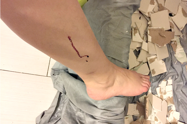injury from DIY shower tile removal